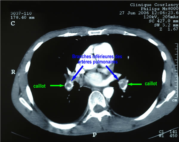 Diagnostic d'une embolie pulmonaire bilaterale a l'angioscanner photo