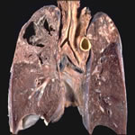 cancer poumon tumeur neuroendocrine